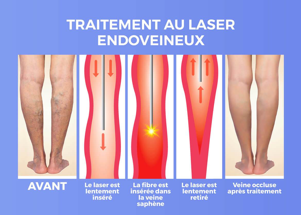 Traitement varices au laser endo veineux et stripping de varices à Vannes